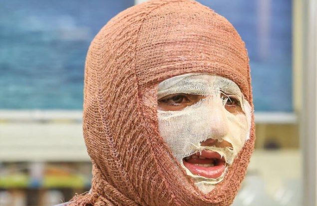 «جان نو» به کمک بیماران سوختگی می‌آید